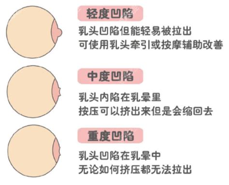 乳頭有毛|乳頭內凹、長毛正常嗎？ 8類「乳頭形狀」你的是哪種 